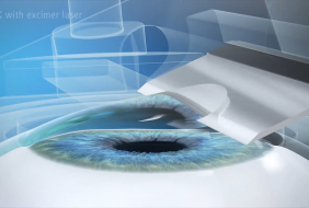 LASIK – PHẪU THUẬT KHÚC XẠ THƯỜNG QUY