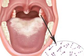 NHỮNG ĐIỀU CẦN BIẾT VỀ BỆNH BẠCH HẦU