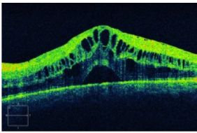 Phù hoàng điểm dạng nang (Cytoids Macular Edema) Khoa Tổng hợp – BV Mắt TP.HCM