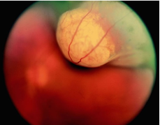 MELANOMA HẮC MẠC