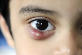 Chắp- Lẹo mắt, cách nhận biết, điều trị và phòng ngừa