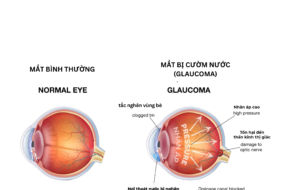 TÌM HIỂU VỀ BỆNH GLAUCOMA (BỆNH CƯỜM NƯỚC)