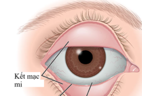 VIÊM KẾT MẠC DO ADENOVIRUS
