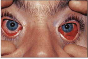 VIÊM KẾT MẠC DO ENTEROVIRUS