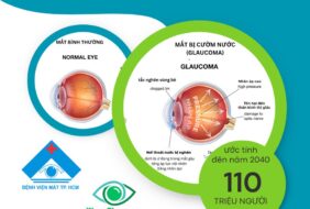 Khoa Glaucoma cải cách trong công tác truyền thông