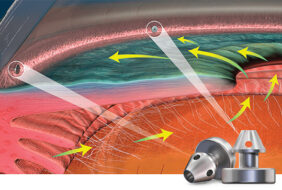 ISTENT INJECT – PHƯƠNG PHÁP ĐIỀU TRỊ MỚI CHO BỆNH NHÂN GLAUCOMA