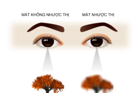 NHƯỢC THỊ – CẬP NHẬT THÔNG TIN VÀ CÁC PHƯƠNG PHÁP ĐIỀU TRỊ MỚI