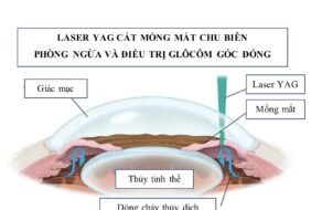 LASER YAG TRONG PHÒNG NGỪA VÀ ĐIỀU TRỊ GLÔCÔM GÓC ĐÓNG