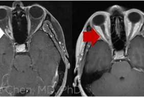 ĐIỀU TRỊ VIÊM THẦN KINH THỊ GIÁC: NHỮNG LƯU Ý KHI SỬ DỤNG CORTICOID LÂU DÀI