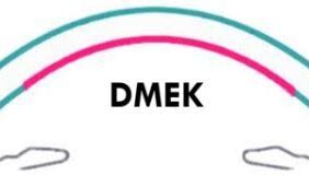 Thêm 1 ca ghép giác mạc thành công bằng kỹ thuật DMEK